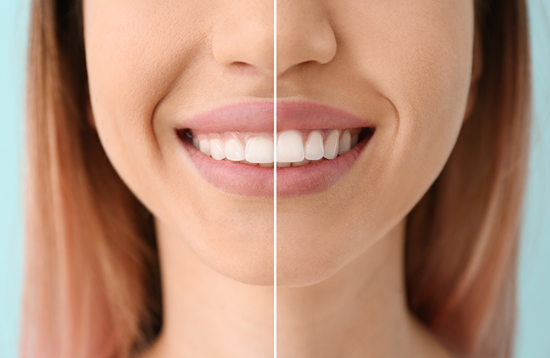 Greenfield Dental Center | Orthodontics, CBCT and Implant Restorations